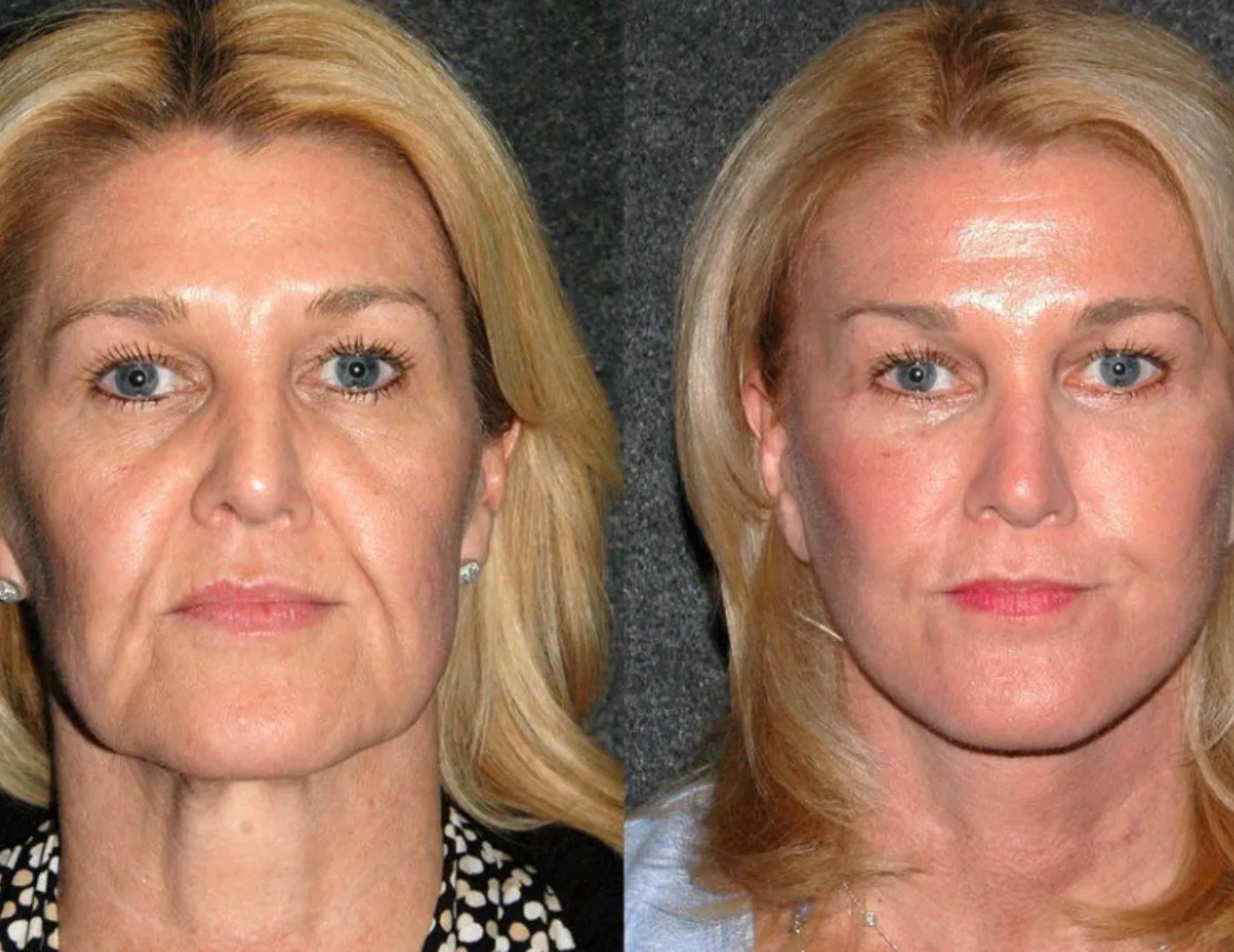 Antes y después Margarita K.
