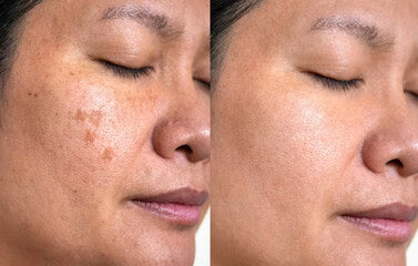 Suero Corrector de Manchas Oscuras con Vitamina C para Hiperpigmentación, Melasma y Marcas de Acné en Rostro y Manos